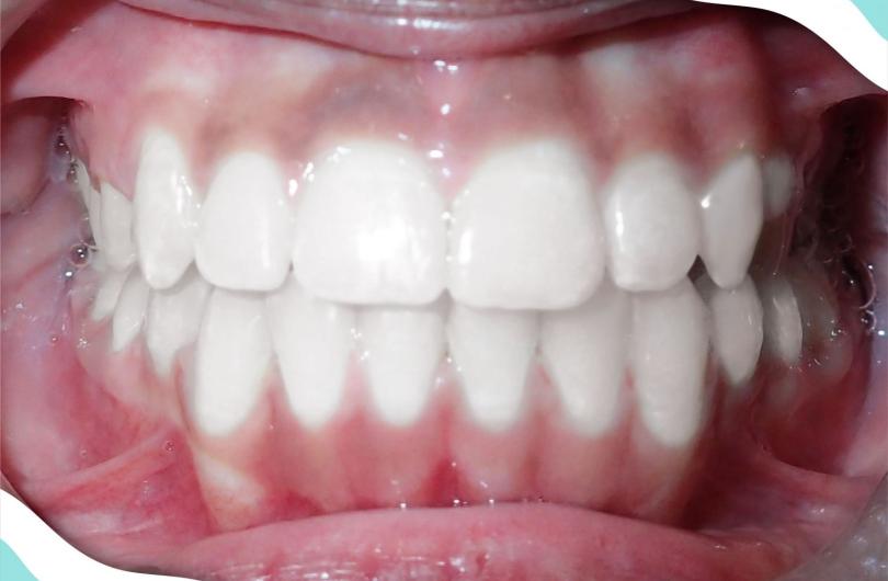 After Braces
