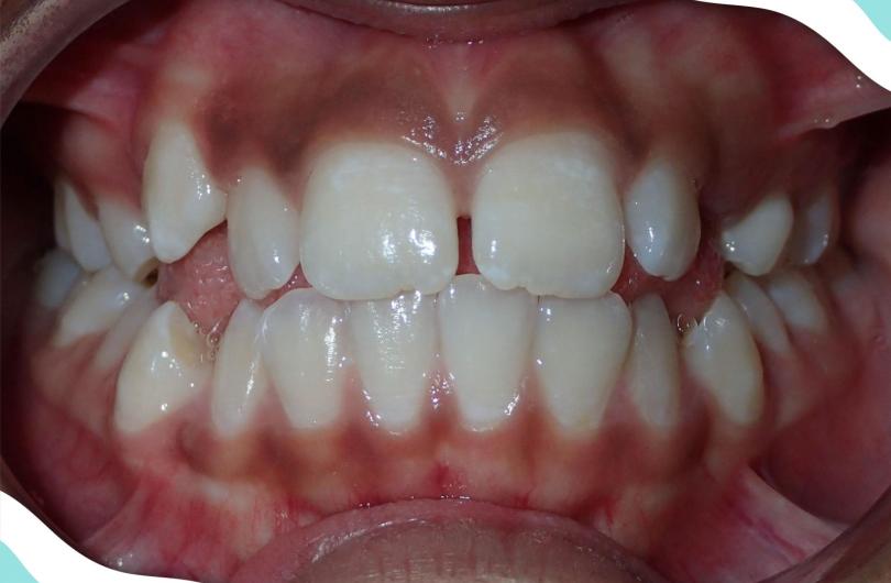 Before Braces